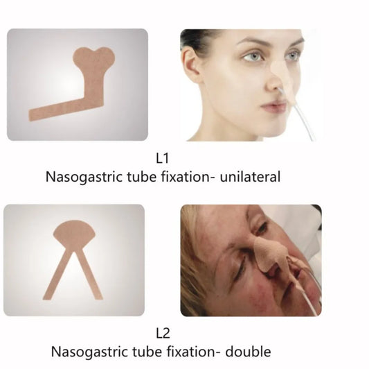 Buy Nasogastric Tube Fixation Solutions for Healthcare